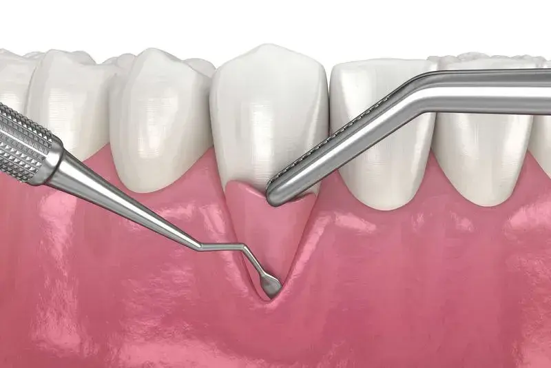 Dental instruments measuring gum recession during periodontal examination procedure.