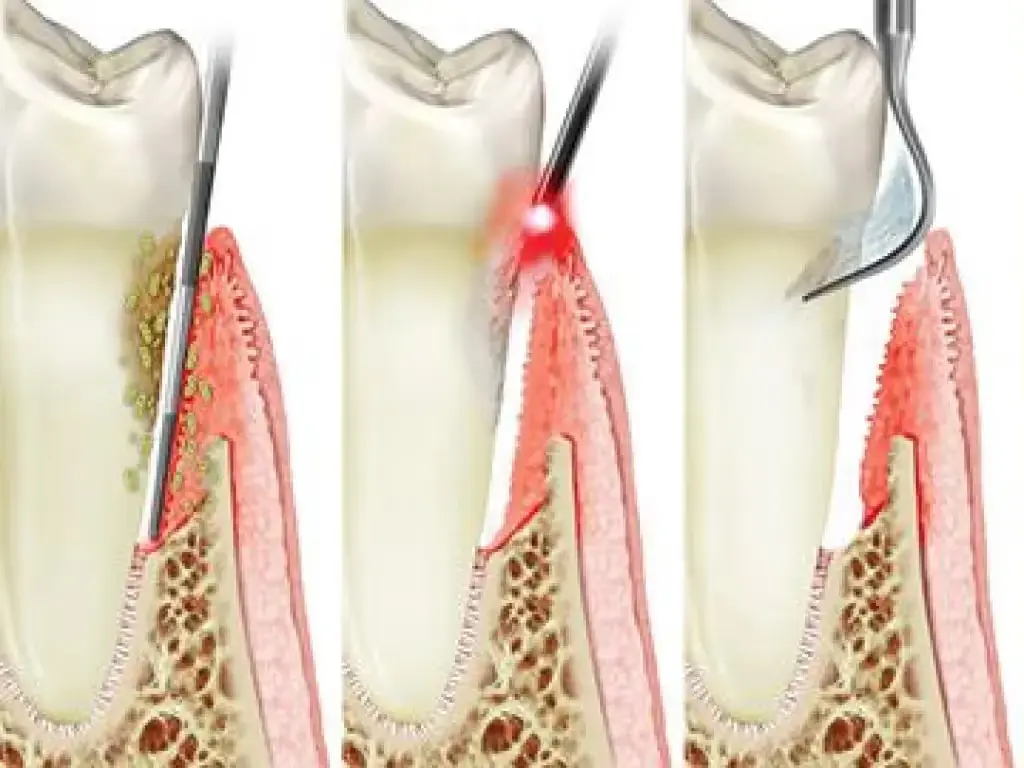 Dental diagram showing three stages of gum disease progression and inflammation around tooth structure.