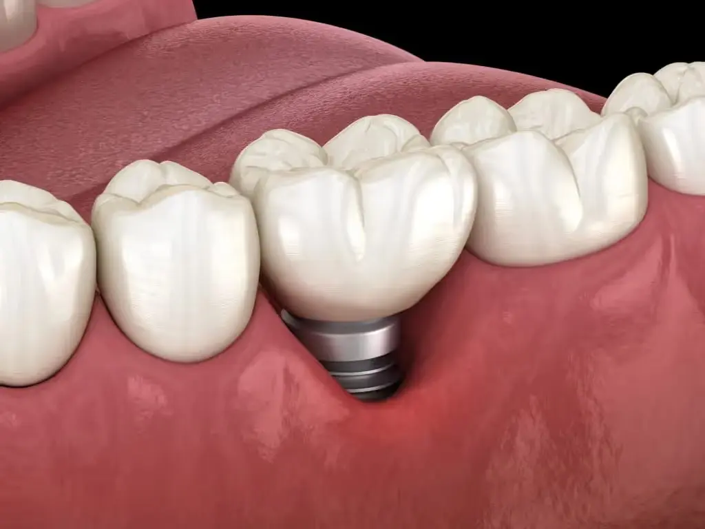 Dental implant model showing crown placement on implant post in gum tissue.