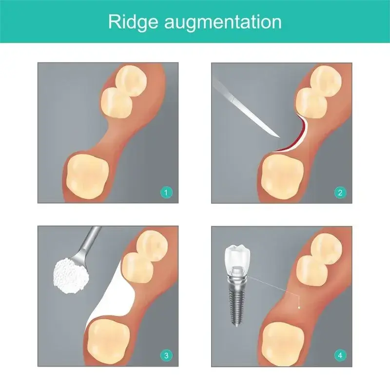 Four-step dental ridge augmentation procedure showing bone graft placement and implant installation process.