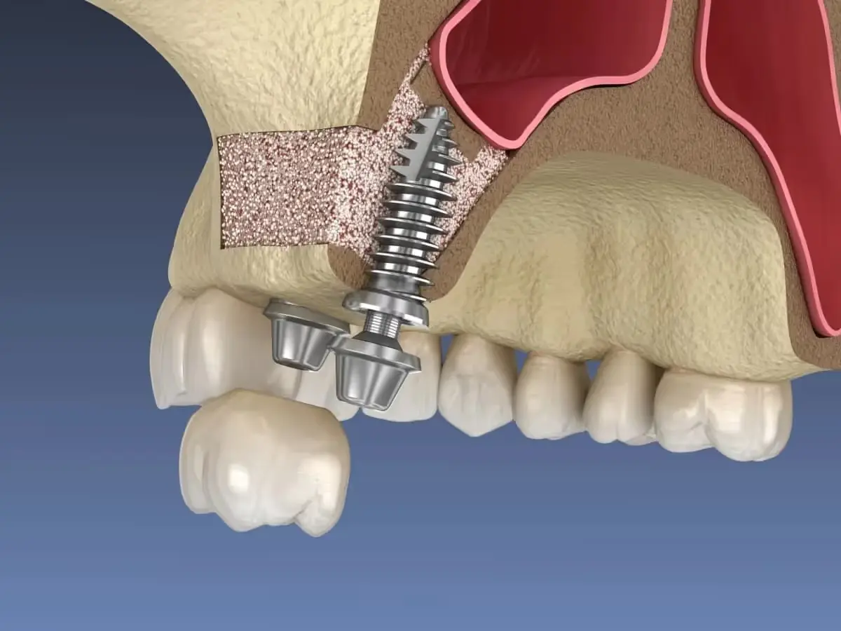 Dental implant 3D illustration showing screw fixture placement in jawbone with crown restoration.