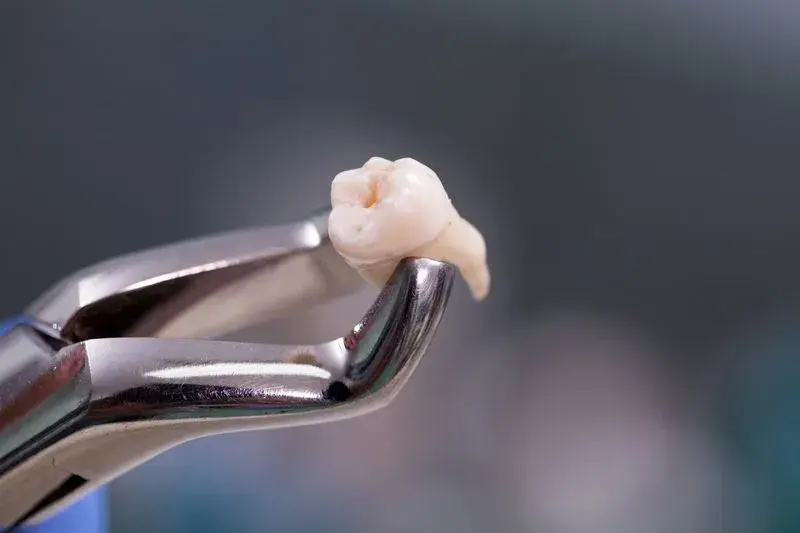 Dental forceps holding extracted tooth against blurred clinical background