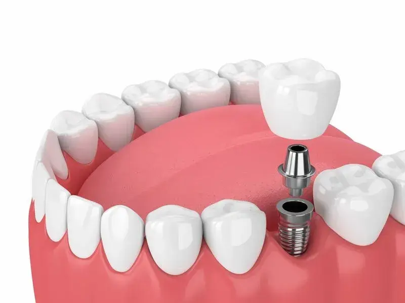 Dental implant model showing tooth replacement procedure with crown and screw components in jaw.