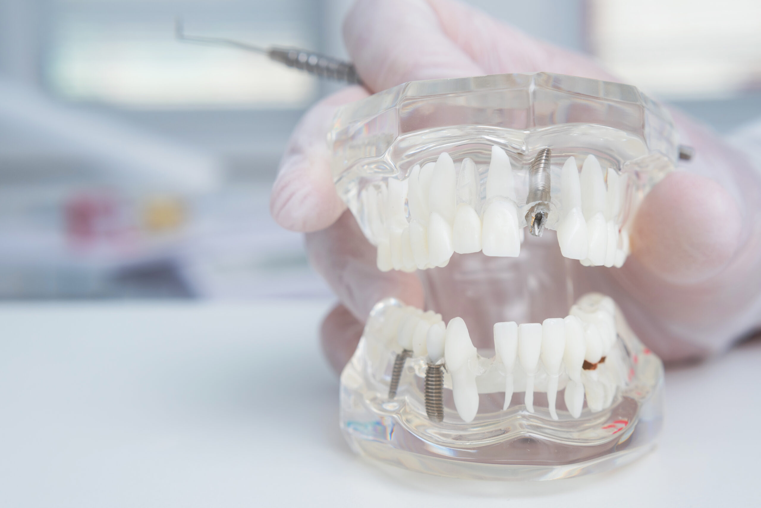 Featured image for “What I Wish I Knew Before Dental Implants”