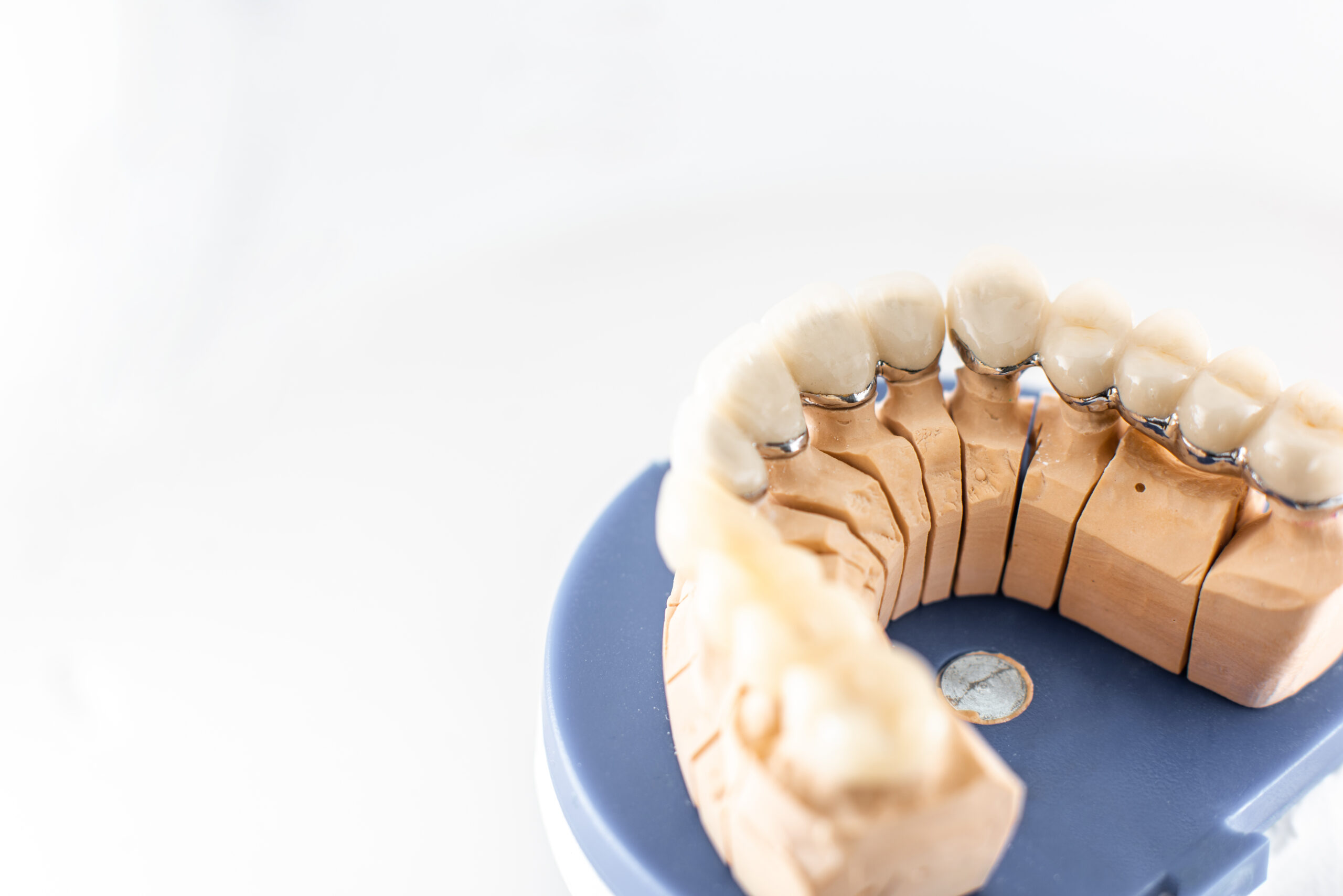 Featured image for “At What Age Are Dental Implants Not Recommended?”