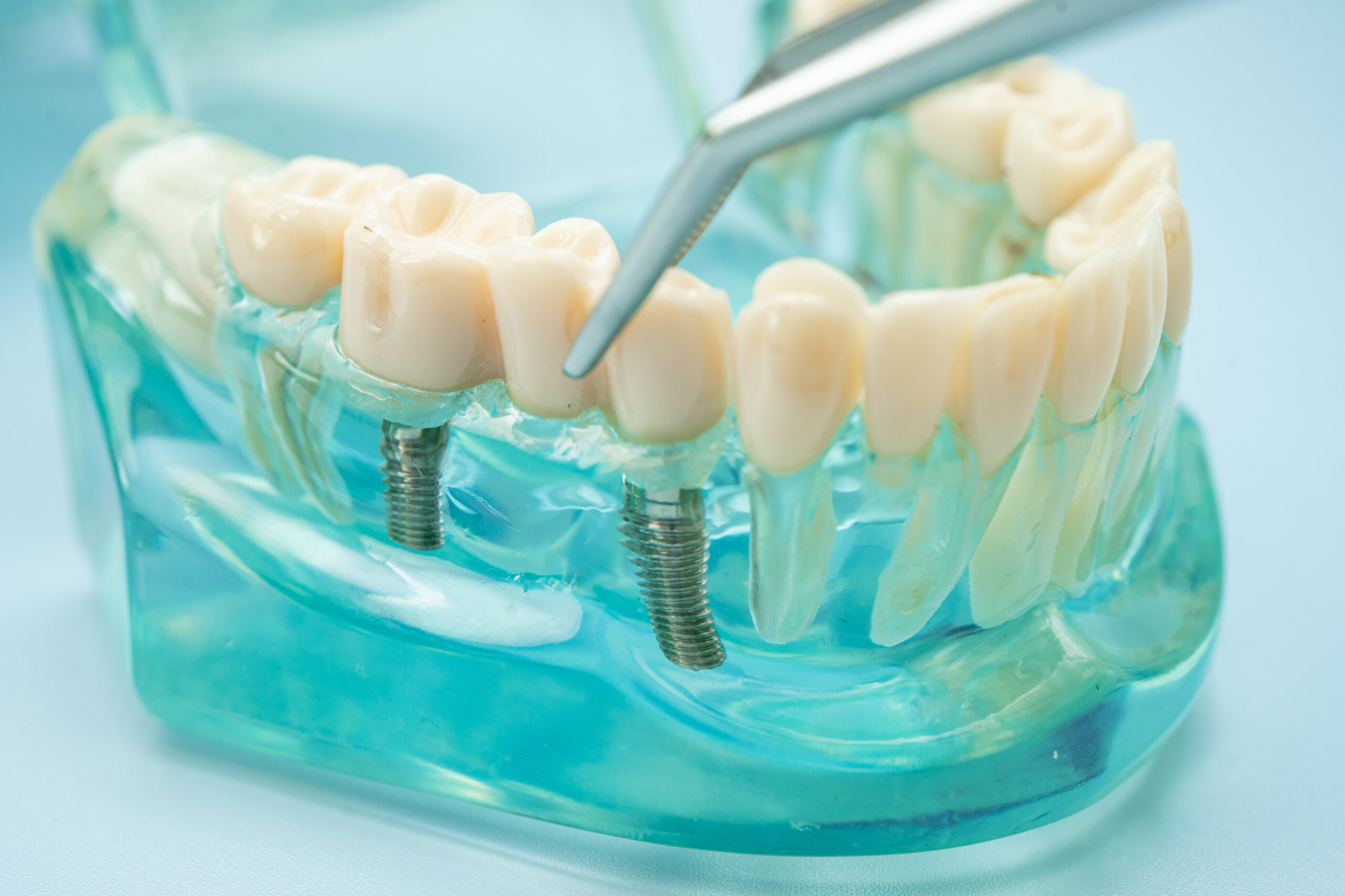 Featured image for “Is It Better to Go to an Oral Surgeon or a Periodontist for Dental Implants?”