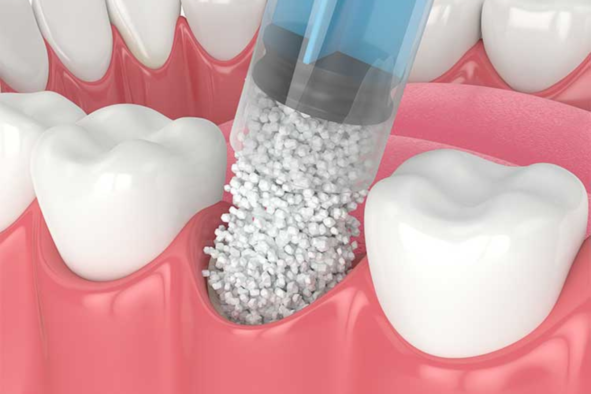 Featured image for “Protect Your Smile: Understanding Gum Grafting and Why It Matters”
