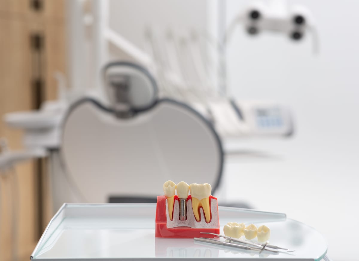 Featured image for “Am I Actually a Good Candidate for Dental Implants”